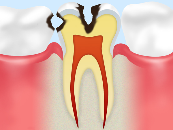 象牙質にまで進行した虫歯